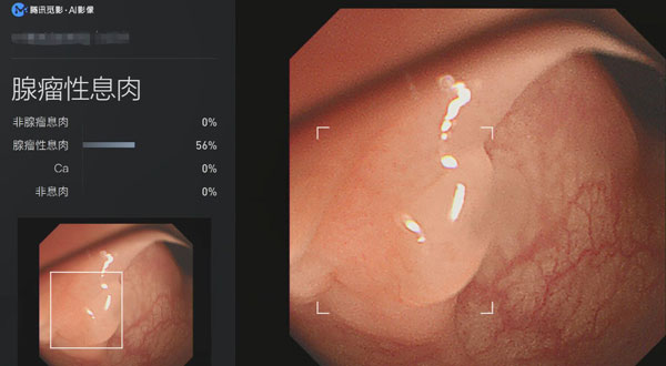 腾讯觅影发布国内首个结直肠肿瘤实时筛查AI系统
